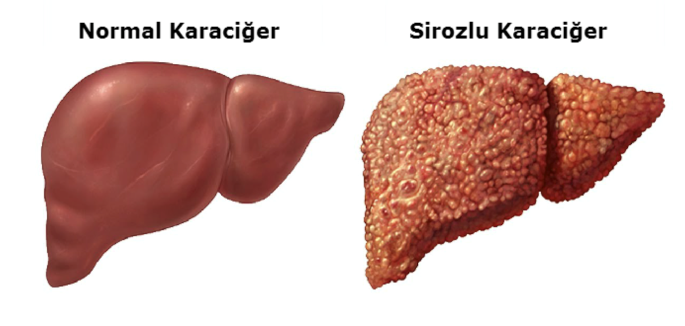 sirozciger