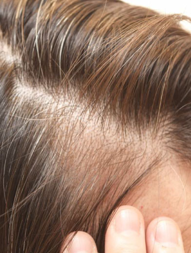 Saç Egzaması Nasıl Geçer? Saç Egzamasına iyi Gelecek 5 Öneri