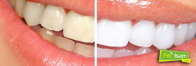 Doğal Yöntemlerle Diş Beyazlatma