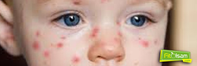 Su Çiçeği Belirtileri