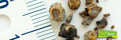 Böbrek Taşı Tedavi Yöntemleri