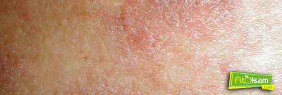 Mantar Hastalığı için Doğal Tedavi Yöntemleri