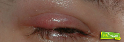 Arpacık Nedir? Nasıl Tedavi Edilir?