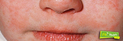 Kızamık Hastalığı Belirtileri ve Tedavisi