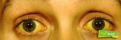 Sarılık Nedir? Belirtileri Nelerdir?