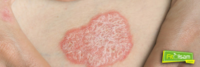 Sedef Hastalığı için Doğal Tedavi Yöntemleri Nelerdir?