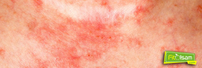 Egzama İçin Doğal Tedavi Yöntemleri