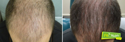 PRP Saç Ekleme Tedavisi