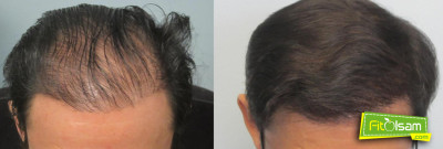 Saç Ekimi Nedir? Nasıl Yapılır?