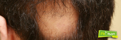 Saçkıran Nedir? Nasıl Tedavi Edilir?