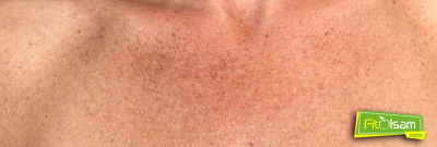 Güneş Lekeleri Nasıl Geçer?