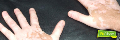 Vitiligo ve Tedavisi