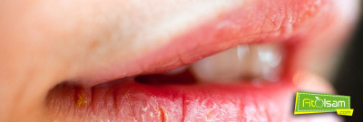 Doğal Yöntemlerle Dudak Çatlaması Nasıl Önlenir?