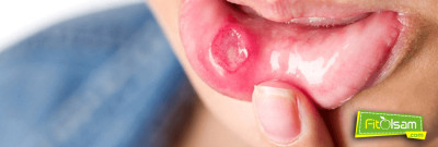 Behçet Hastalığı Nedir?