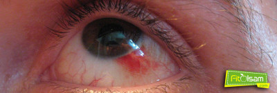 Göz Kanamaları Neden Olur Ve Nasıl Tedavi Edilir ?