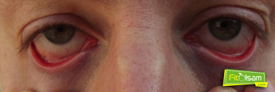 Konjonktivit Nedir? Tedavisi Nasıl Olmalıdır?