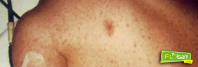 Tifüs Hastalığı Nedir? Tedavisi Nasıl Yapılır ?