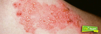 Zona Hastalığı Nedir? Belirtileri Ve Tedavi Yöntemleri Nelerdir ?