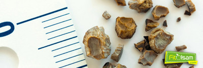 Böbrek Taşı Nedir? Risk Oluşturan Faktörler Ve Tedavi Yöntemleri Nelerdir?