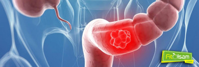 Kolon (Kalın Bağırsak) Kanseri Nedir? Belirtileri Ve Tedavi Yöntemleri Nelerdir?