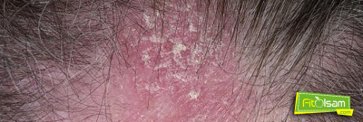 Saçlarda Oluşan Sedef ve Egzamaya Bitkisel Yolla Nasıl Tedavi Edilir?