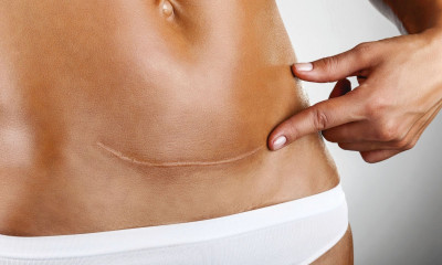 Sezeryen Doğumun Zorlukları ve Ağrılarından Kurtulmanın Yolları Nelerdir?