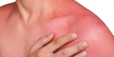 Yanık İçin En Etkili Esansiyel Yağlar