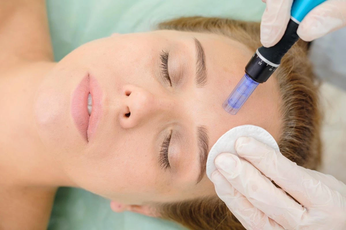 dermapen nedir dermapen cilde nasil uygulanir yasam ve stil fit olsam