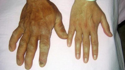 Akromegali Nedir? Belirtileri ve Tedavi Yöntemleri Nelerdir?