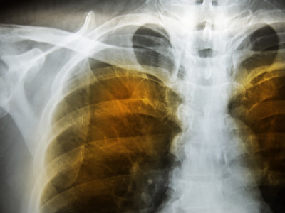 Amfizem Nedir? Nedenleri ve Tedavi Yöntemleri Nelerdir?