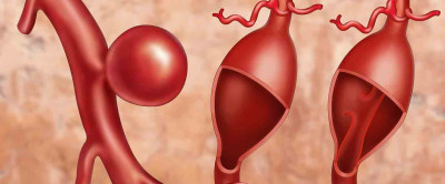 Anevrizma Hastalığı Nedir? Tedavi Yöntemleri Nelerdir?