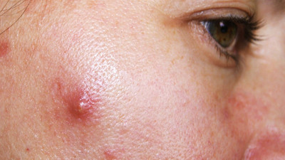 Çıban Nedir? Belirtileri ve Tedavi Yolları Nelerdir?