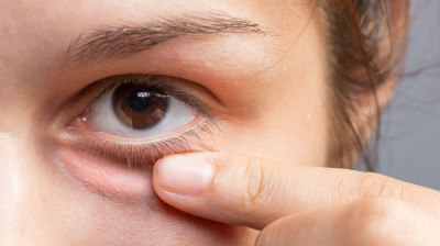 Arpacık Belirtileri Nelerdir? Tedavisi Nasıl Yapılır?