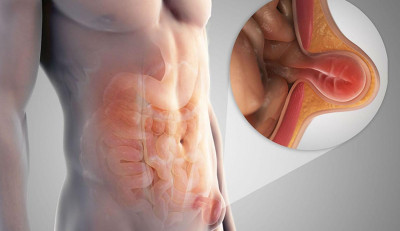 Kasık Fıtığı Nedir ve Neden Olur?