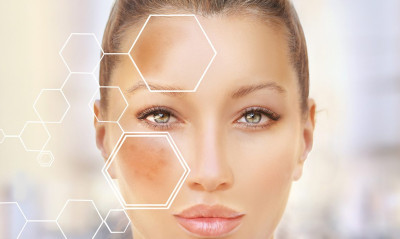 Hiperpigmentasyon Nedir?