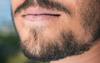 Sakal Kıran Nedir? Tedavisi Nasıl Yapılır?