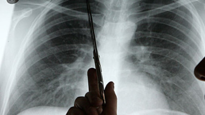 Bronş (Akciğer) Kanseri Nedir? Tedavi Yöntemleri Nelerdir?