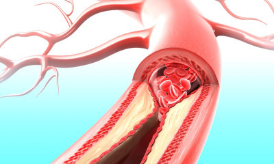 Damar Açıcı Gıdalar Hangileridir? Bitkisel Damar Açan Besinler Nelerdir? 