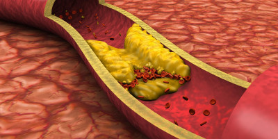 Hiperlipidemi Nedir?