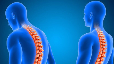 Kifoz Nedir? Tedavi Yöntemleri ve Belirtileri Nelerdir?