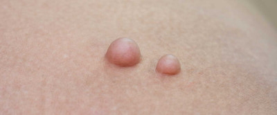 Lipom (Yağ Bezesi) Nedir? Tedavi Yöntemleri Nelerdir?