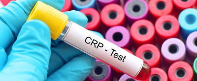 CRP (C Reaktif Protein) Nedir? CRP Yüksekliği Neden Olur?